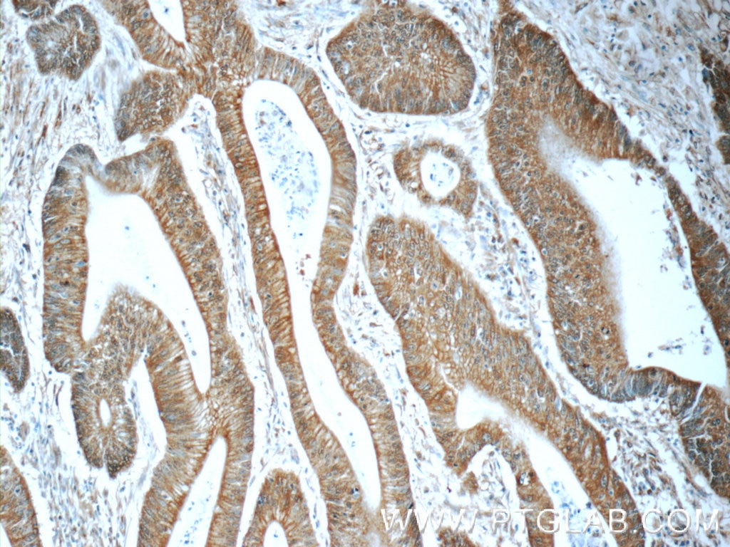 Immunohistochemistry (IHC) staining of human colon cancer tissue using BEND4 Polyclonal antibody (24711-1-AP)