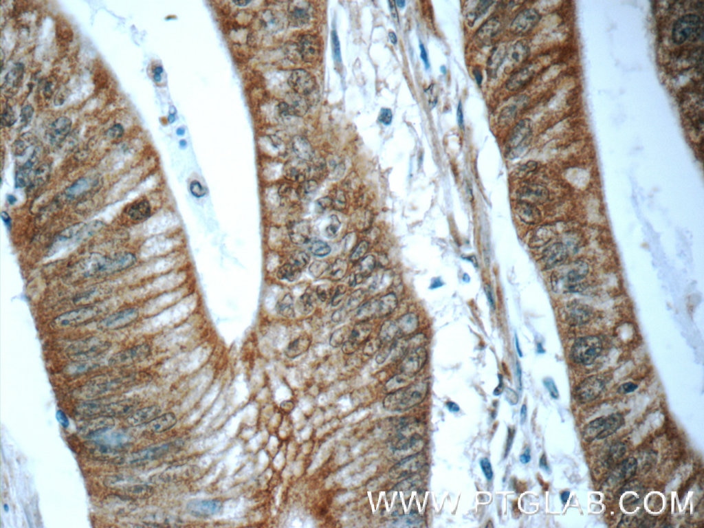 Immunohistochemistry (IHC) staining of human colon cancer tissue using BEND4 Polyclonal antibody (24711-1-AP)