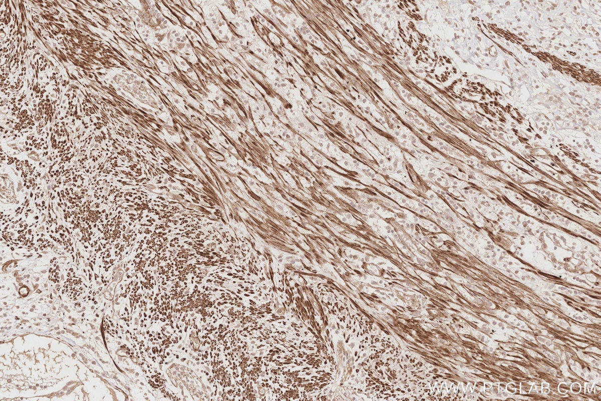 Immunohistochemistry (IHC) staining of human appendicitis tissue using BEX1/2 Polyclonal antibody (12390-1-AP)