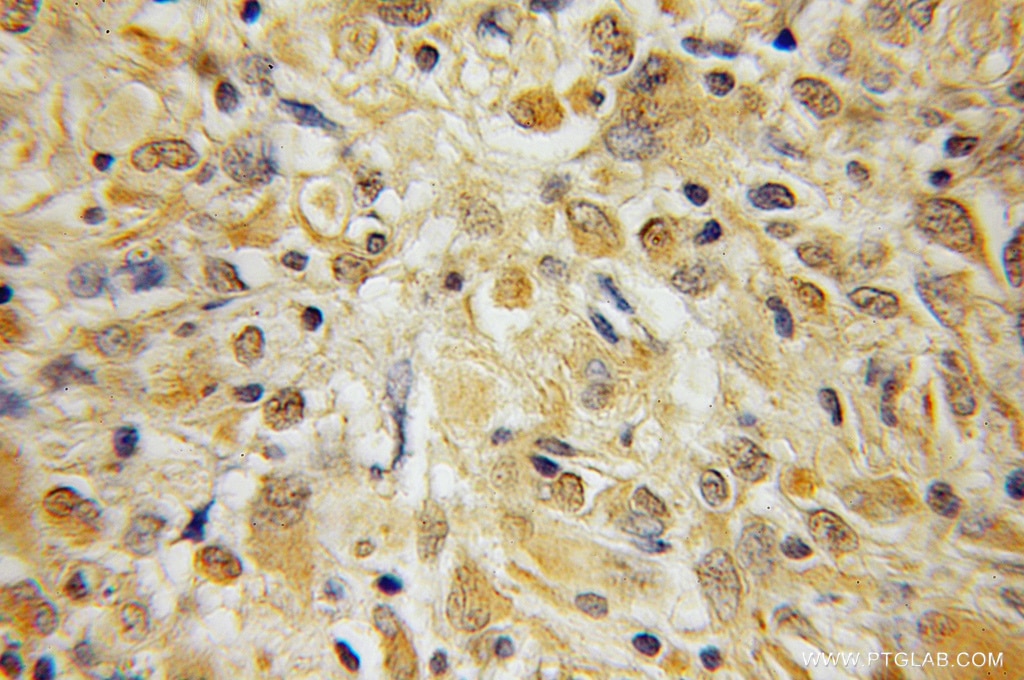 Immunohistochemistry (IHC) staining of human medulloblastoma tissue using BEX1/2 Polyclonal antibody (12390-1-AP)