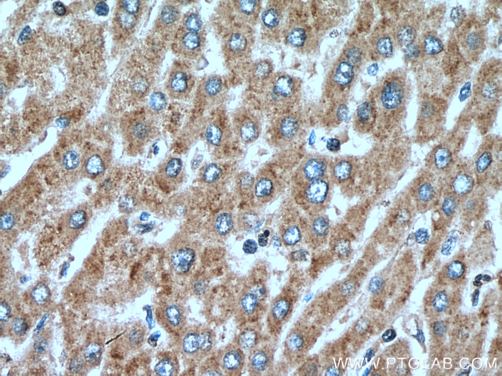 Immunohistochemistry (IHC) staining of human liver cancer tissue using BEX5 Polyclonal antibody (25281-1-AP)