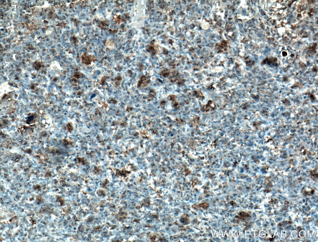 Immunohistochemistry (IHC) staining of human osteosarcoma tissue using Osteocalcin Polyclonal antibody (16157-1-AP)