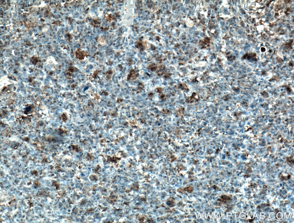 Immunohistochemistry (IHC) staining of human osteosarcoma tissue using Osteocalcin/OCN Polyclonal antibody (16157-1-AP)