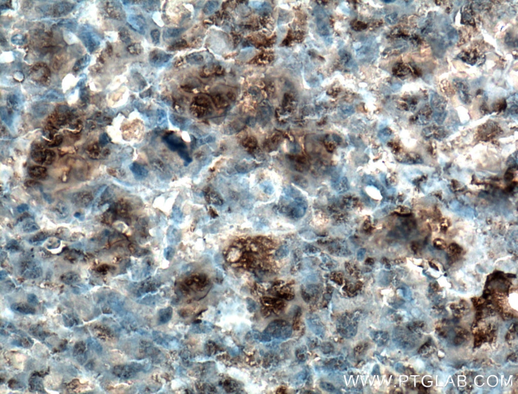 Immunohistochemistry (IHC) staining of human osteosarcoma tissue using Osteocalcin Polyclonal antibody (16157-1-AP)