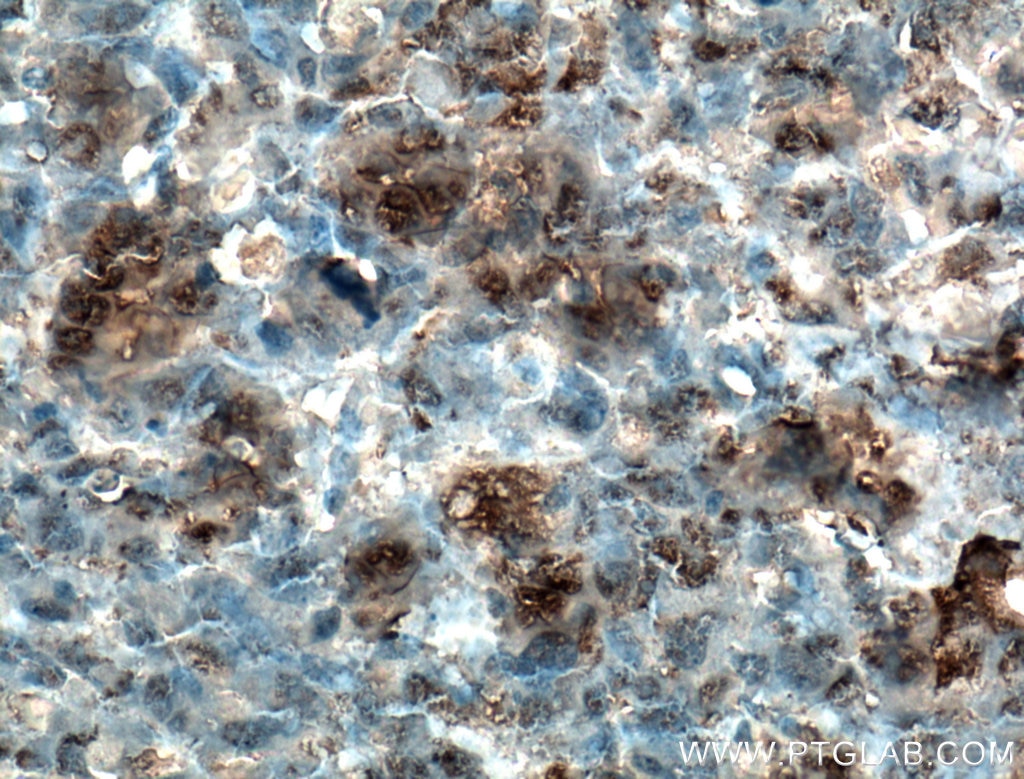 Immunohistochemistry (IHC) staining of human osteosarcoma tissue using Osteocalcin/OCN Polyclonal antibody (16157-1-AP)