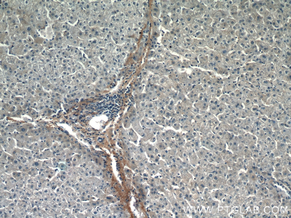 IHC staining of human liver cancer using 16409-1-AP
