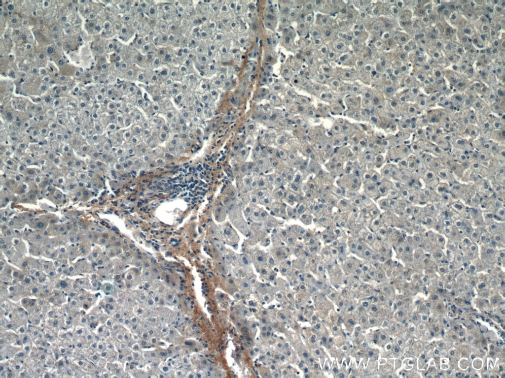 Immunohistochemistry (IHC) staining of human liver cancer tissue using Biglycan Polyclonal antibody (16409-1-AP)