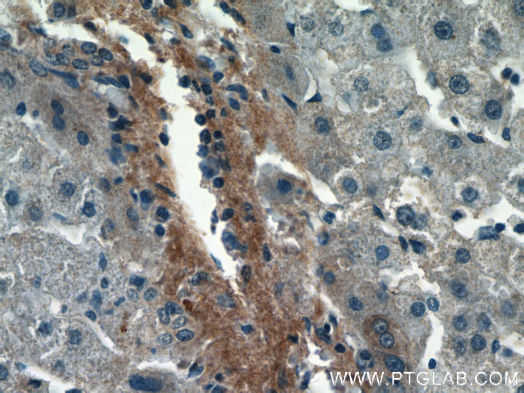 Immunohistochemistry (IHC) staining of human liver cancer tissue using Biglycan Polyclonal antibody (16409-1-AP)