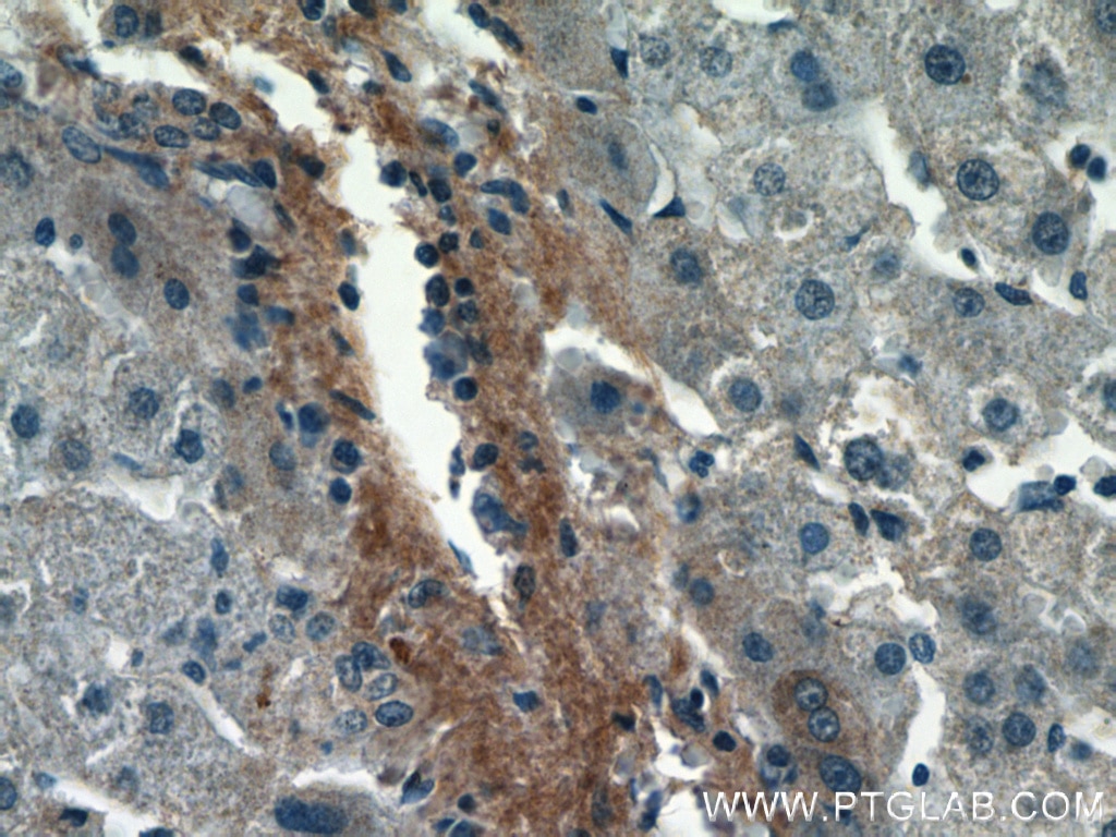 IHC staining of human liver cancer using 16409-1-AP