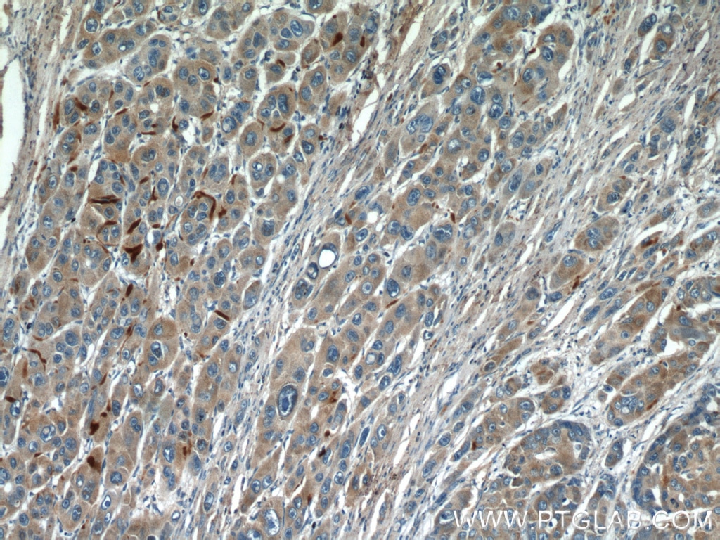 Immunohistochemistry (IHC) staining of human liver cancer tissue using Biglycan Polyclonal antibody (16409-1-AP)