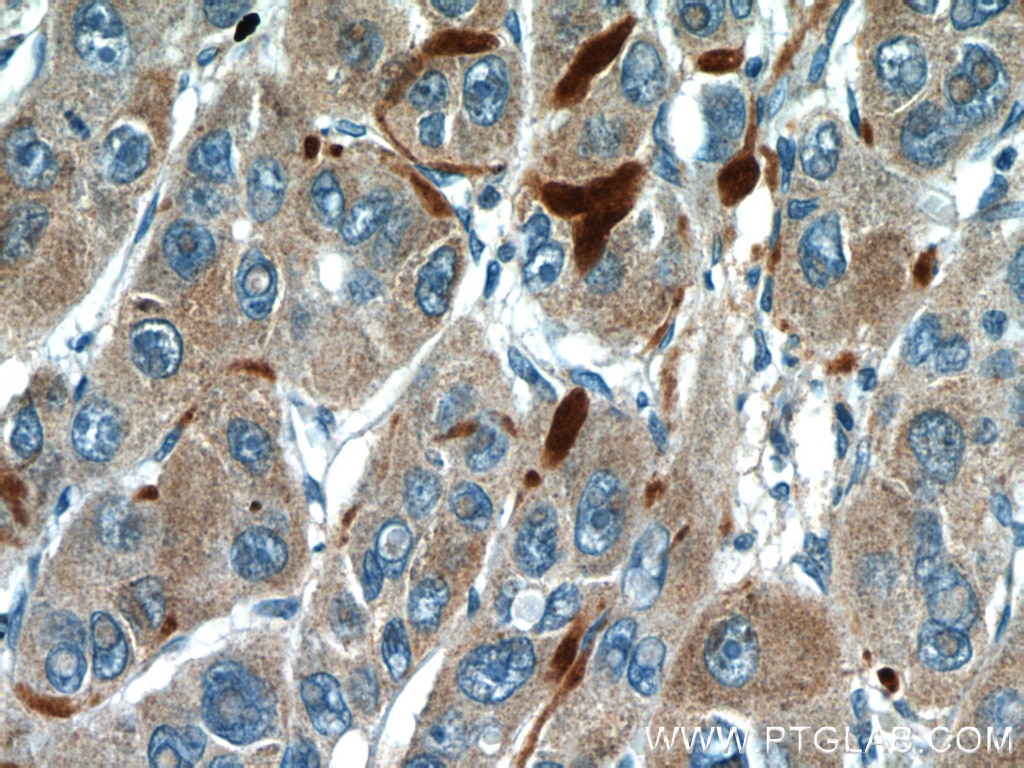 Immunohistochemistry (IHC) staining of human liver cancer tissue using Biglycan Polyclonal antibody (16409-1-AP)