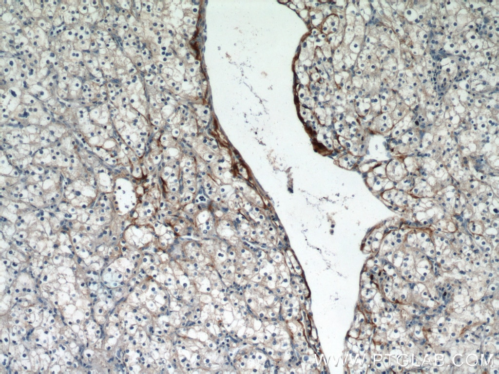 Immunohistochemistry (IHC) staining of human renal cell carcinoma tissue using Biglycan Polyclonal antibody (16409-1-AP)