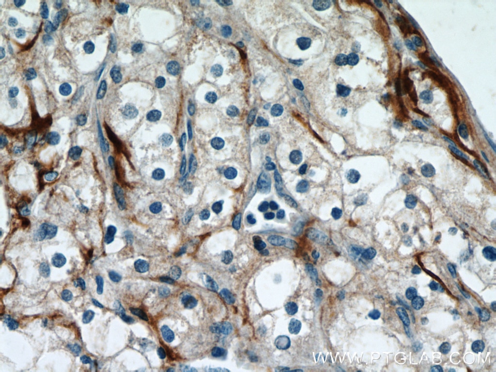 Immunohistochemistry (IHC) staining of human renal cell carcinoma tissue using Biglycan Polyclonal antibody (16409-1-AP)