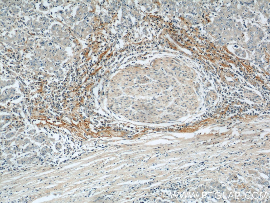 Immunohistochemistry (IHC) staining of human stomach cancer tissue using Biglycan Polyclonal antibody (16409-1-AP)