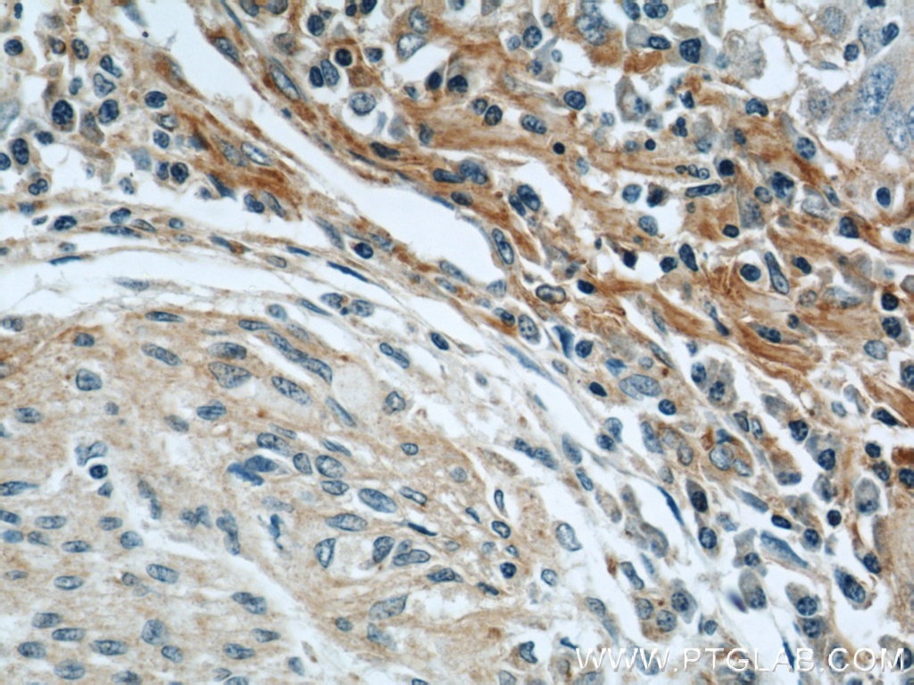 Immunohistochemistry (IHC) staining of human stomach cancer tissue using Biglycan Polyclonal antibody (16409-1-AP)