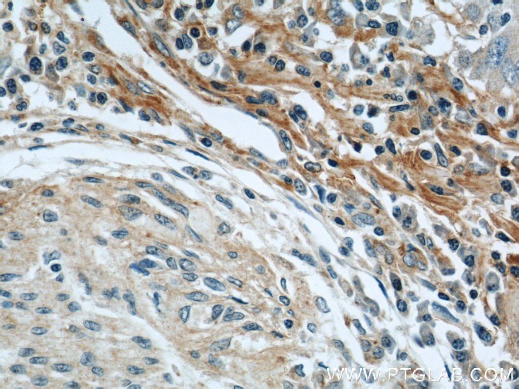 IHC staining of human stomach cancer using 16409-1-AP