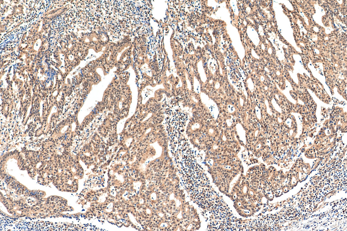 Immunohistochemistry (IHC) staining of human endometrial cancer tissue using BHLHE40 Polyclonal antibody (17895-1-AP)