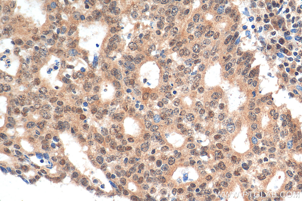 Immunohistochemistry (IHC) staining of human endometrial cancer tissue using BHLHE40 Polyclonal antibody (17895-1-AP)