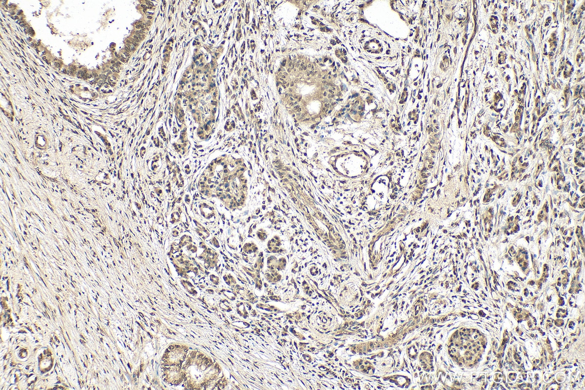 Immunohistochemistry (IHC) staining of human pancreas cancer tissue using BHLHE40 Polyclonal antibody (17895-1-AP)