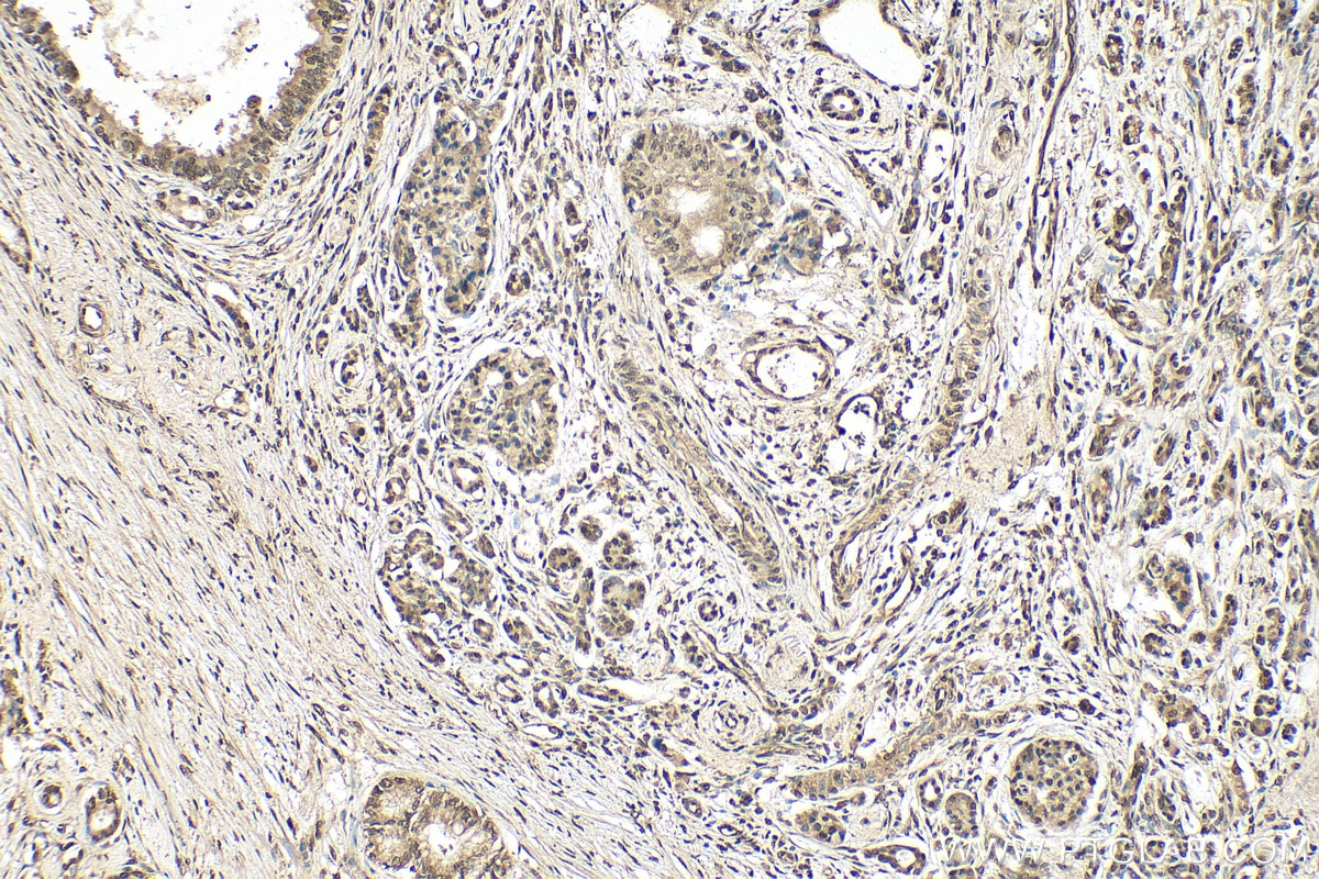 IHC staining of human pancreas cancer using 17895-1-AP