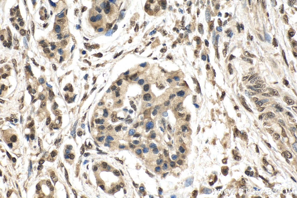 Immunohistochemistry (IHC) staining of human pancreas cancer tissue using BHLHE40 Polyclonal antibody (17895-1-AP)