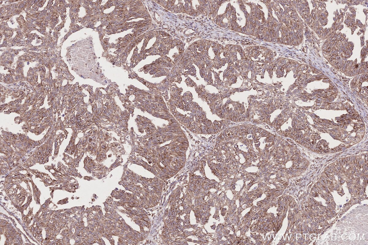 Immunohistochemistry (IHC) staining of human ovary cancer tissue using BICD2 Polyclonal antibody (29603-1-AP)