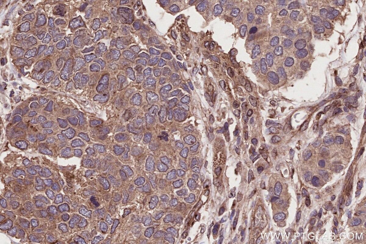 Immunohistochemistry (IHC) staining of human stomach cancer tissue using BICD2 Polyclonal antibody (29603-1-AP)