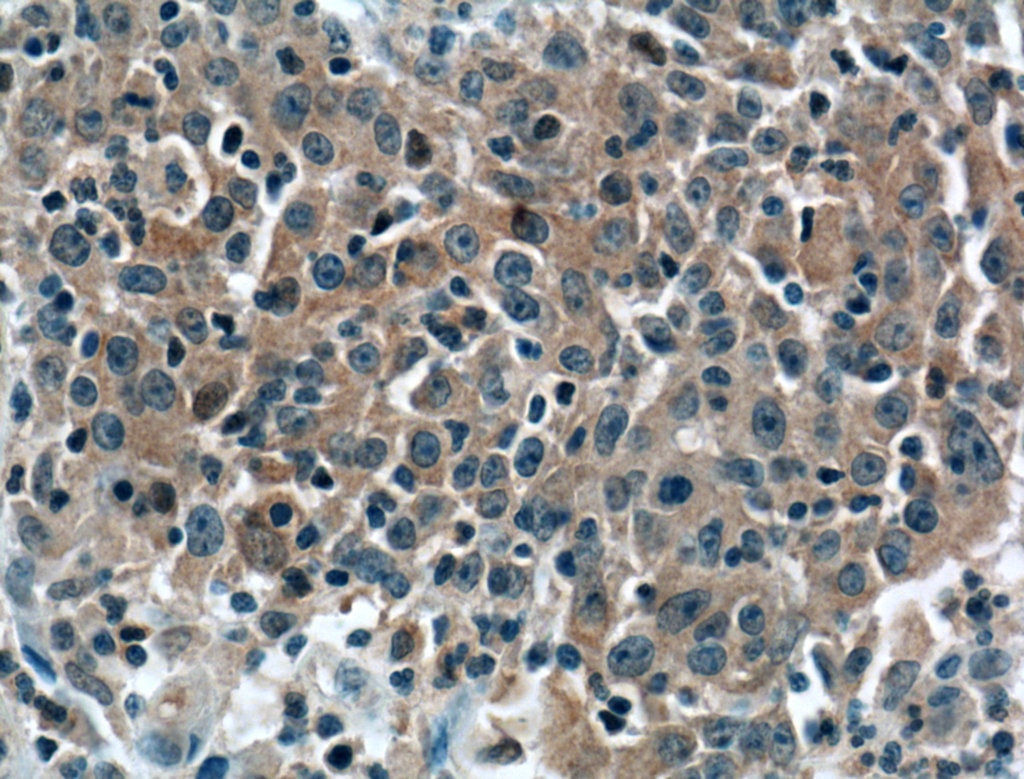Immunohistochemistry (IHC) staining of human colon cancer tissue using BID Monoclonal antibody (60301-1-Ig)