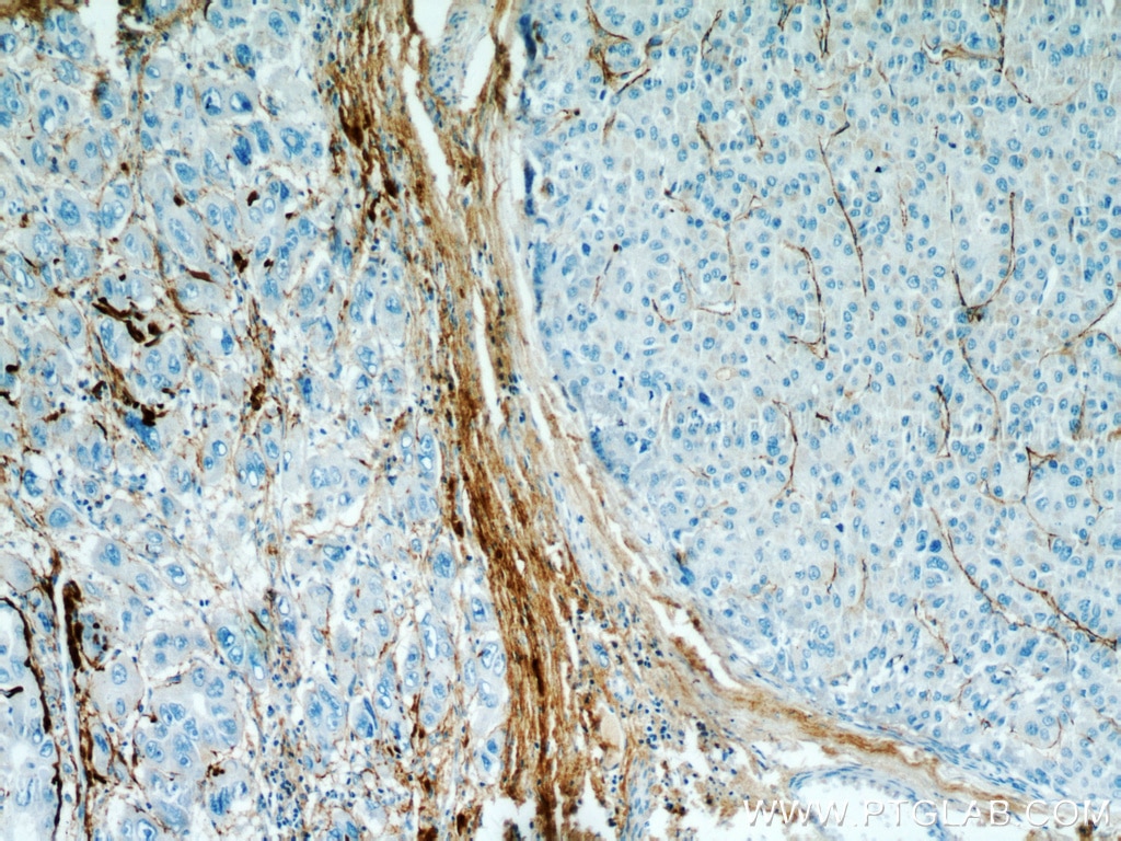 IHC staining of human liver cancer using 10188-1-AP