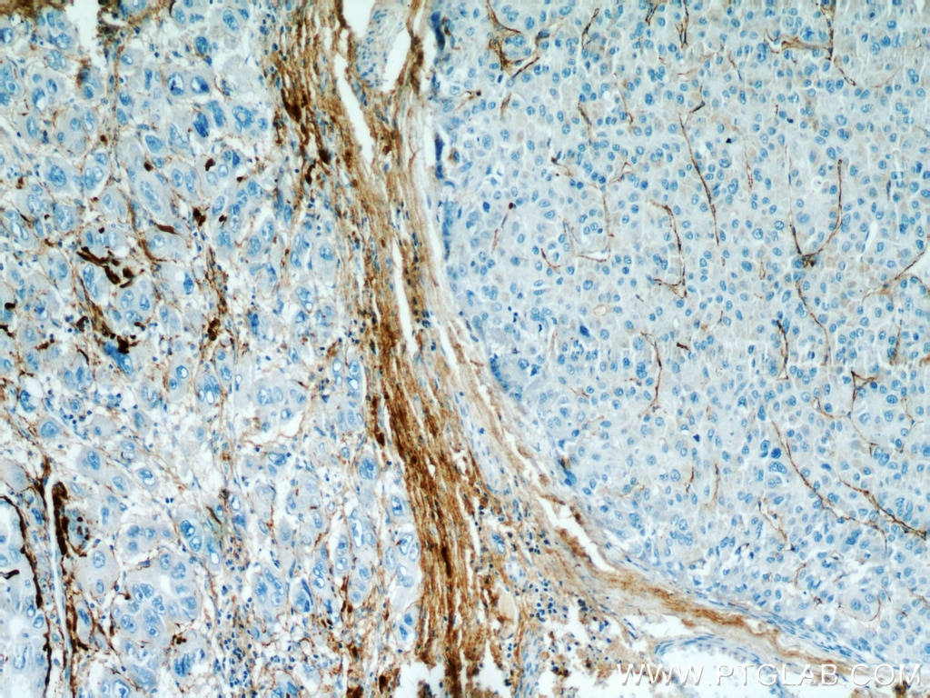 Immunohistochemistry (IHC) staining of human liver cancer tissue using TGFBI / BIGH3 Polyclonal antibody (10188-1-AP)