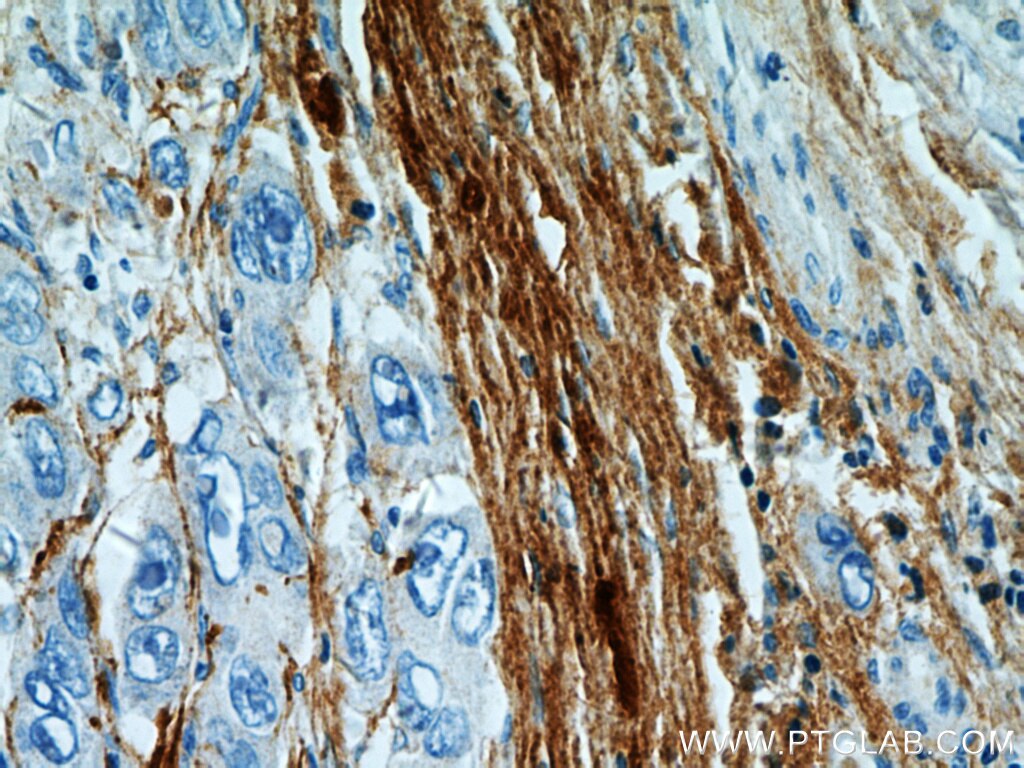 Immunohistochemistry (IHC) staining of human liver cancer tissue using TGFBI / BIGH3 Polyclonal antibody (10188-1-AP)