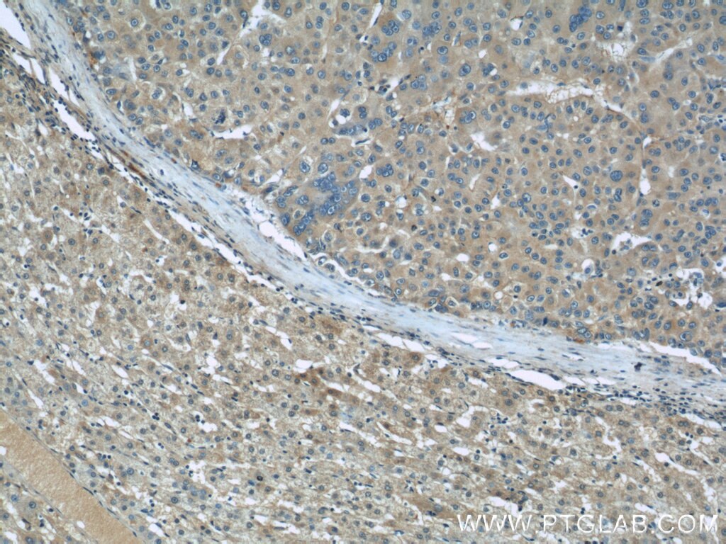 Immunohistochemistry (IHC) staining of human liver cancer tissue using TGFBI / BIGH3 Polyclonal antibody (10188-1-AP)