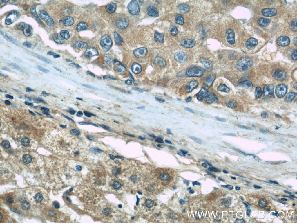 Immunohistochemistry (IHC) staining of human liver cancer tissue using TGFBI / BIGH3 Polyclonal antibody (10188-1-AP)