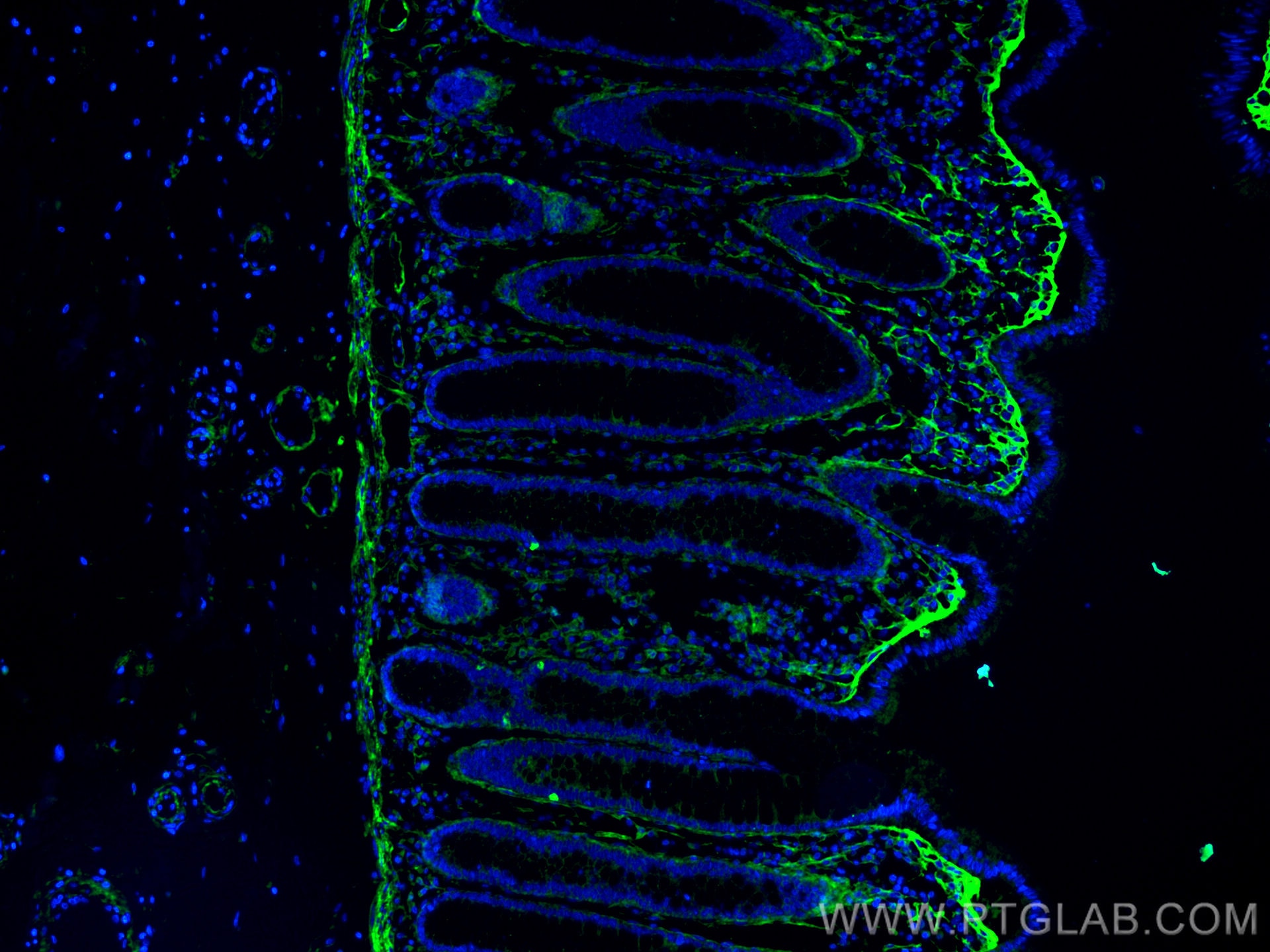 Immunofluorescence (IF) / fluorescent staining of human colon cancer tissue using TGFBI / BIGH3 Monoclonal antibody (60007-1-Ig)