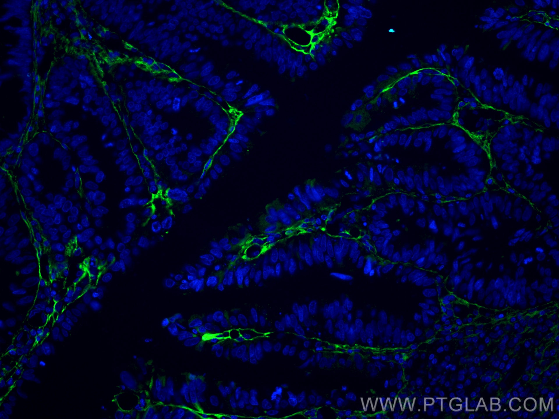 Immunofluorescence (IF) / fluorescent staining of human colon cancer tissue using TGFBI / BIGH3 Monoclonal antibody (60007-1-Ig)