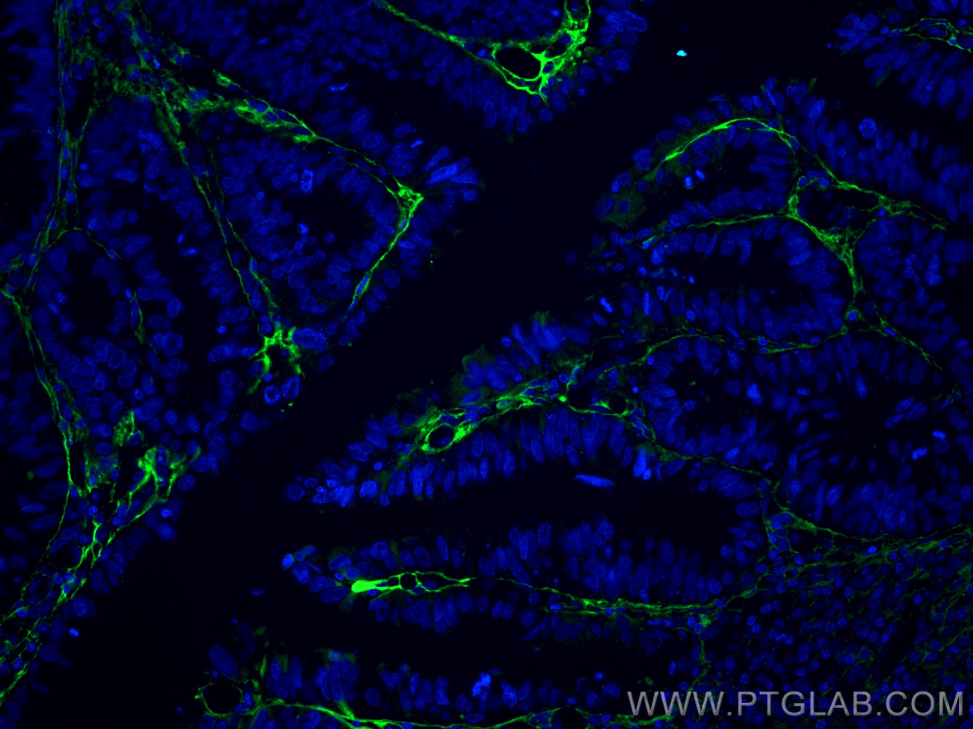 IF Staining of human colon cancer using 60007-1-Ig