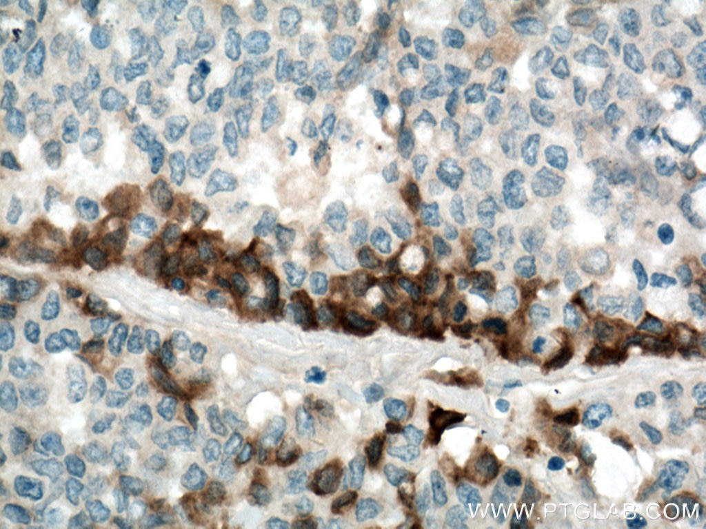 Immunohistochemistry (IHC) staining of human colon cancer tissue using TGFBI / BIGH3 Monoclonal antibody (60007-1-Ig)