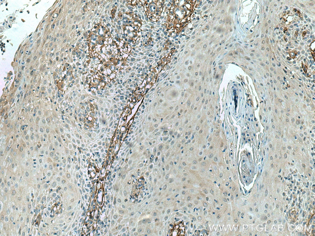 Immunohistochemistry (IHC) staining of human skin cancer tissue using TGFBI / BIGH3 Monoclonal antibody (60007-1-Ig)