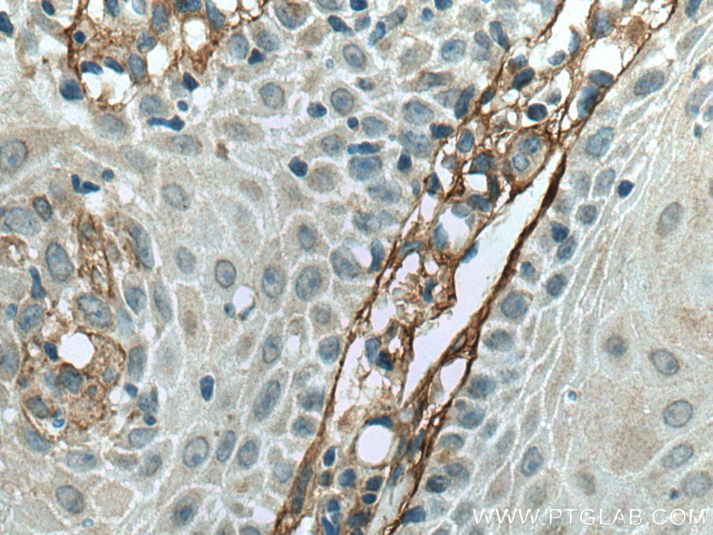 Immunohistochemistry (IHC) staining of human skin cancer tissue using TGFBI / BIGH3 Monoclonal antibody (60007-1-Ig)
