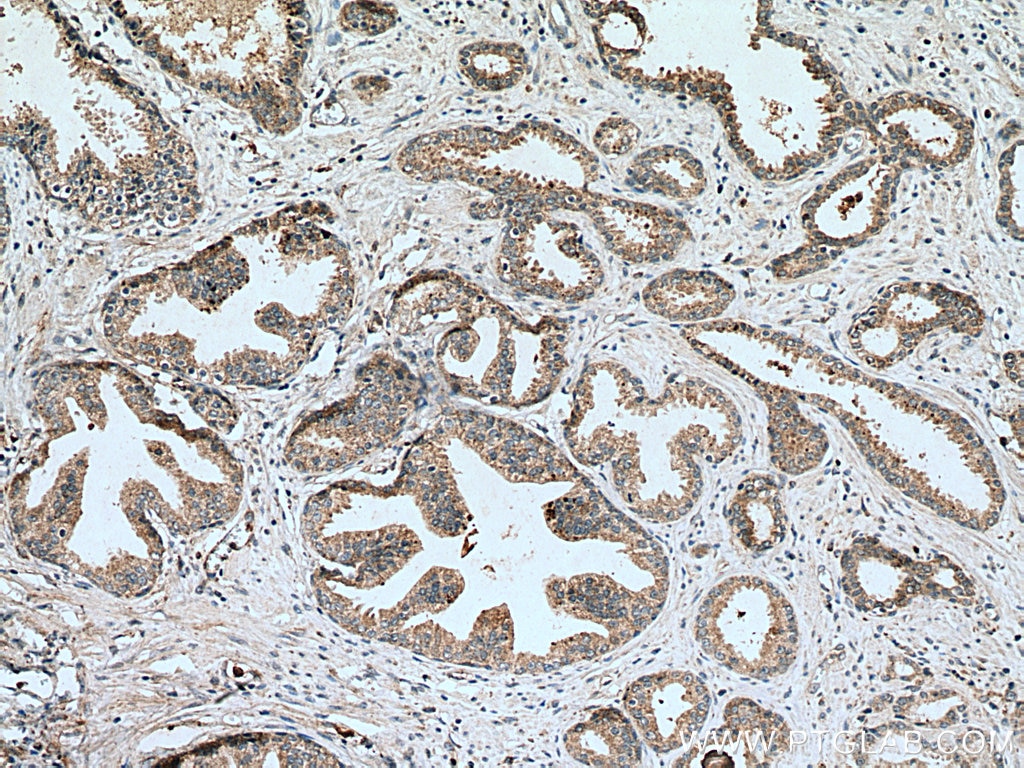 Immunohistochemistry (IHC) staining of human prostate cancer tissue using Bim Polyclonal antibody (22037-1-AP)