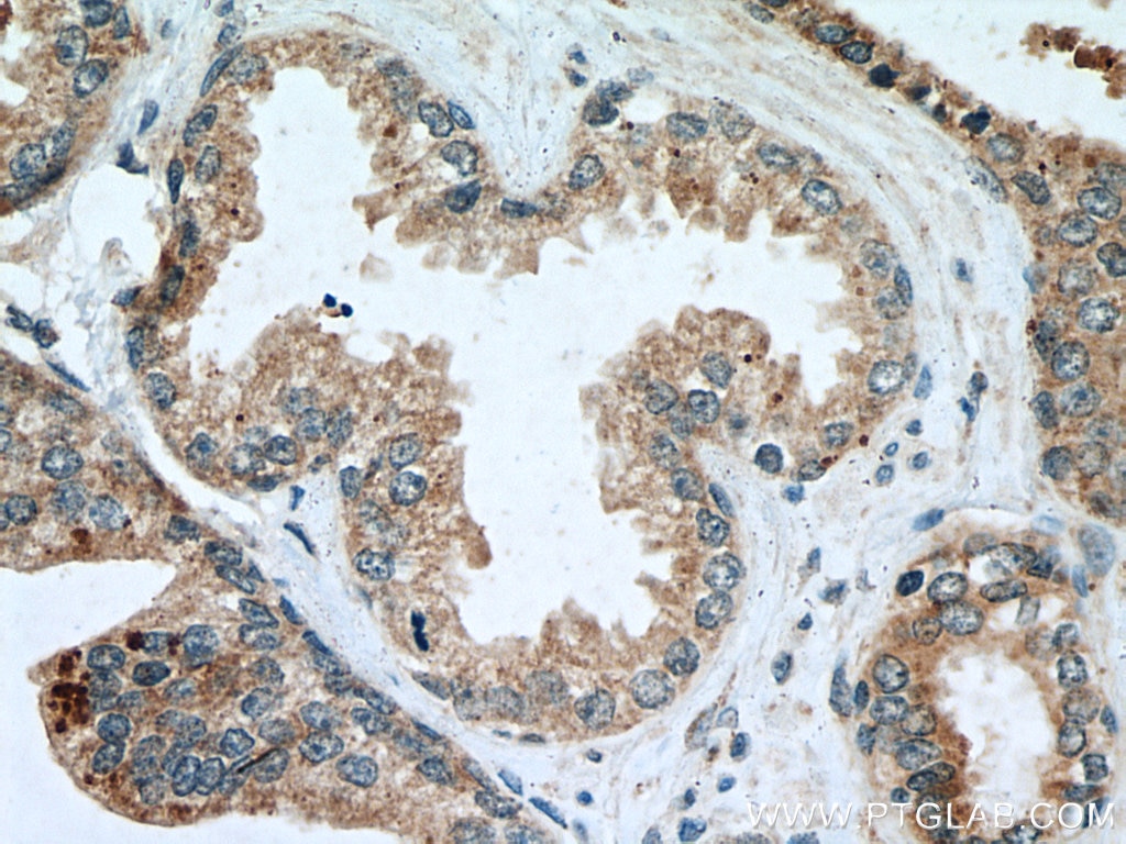 IHC staining of human prostate cancer using 22037-1-AP