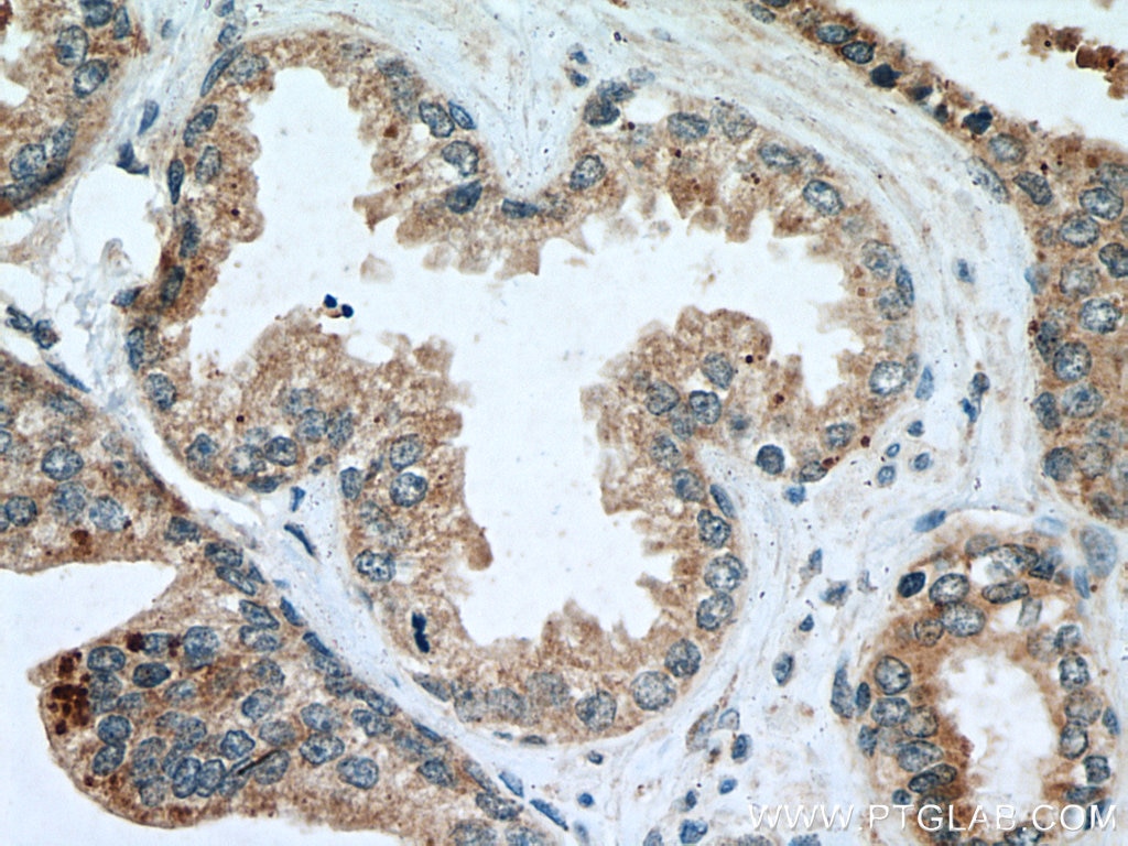 Immunohistochemistry (IHC) staining of human prostate cancer tissue using Bim Polyclonal antibody (22037-1-AP)