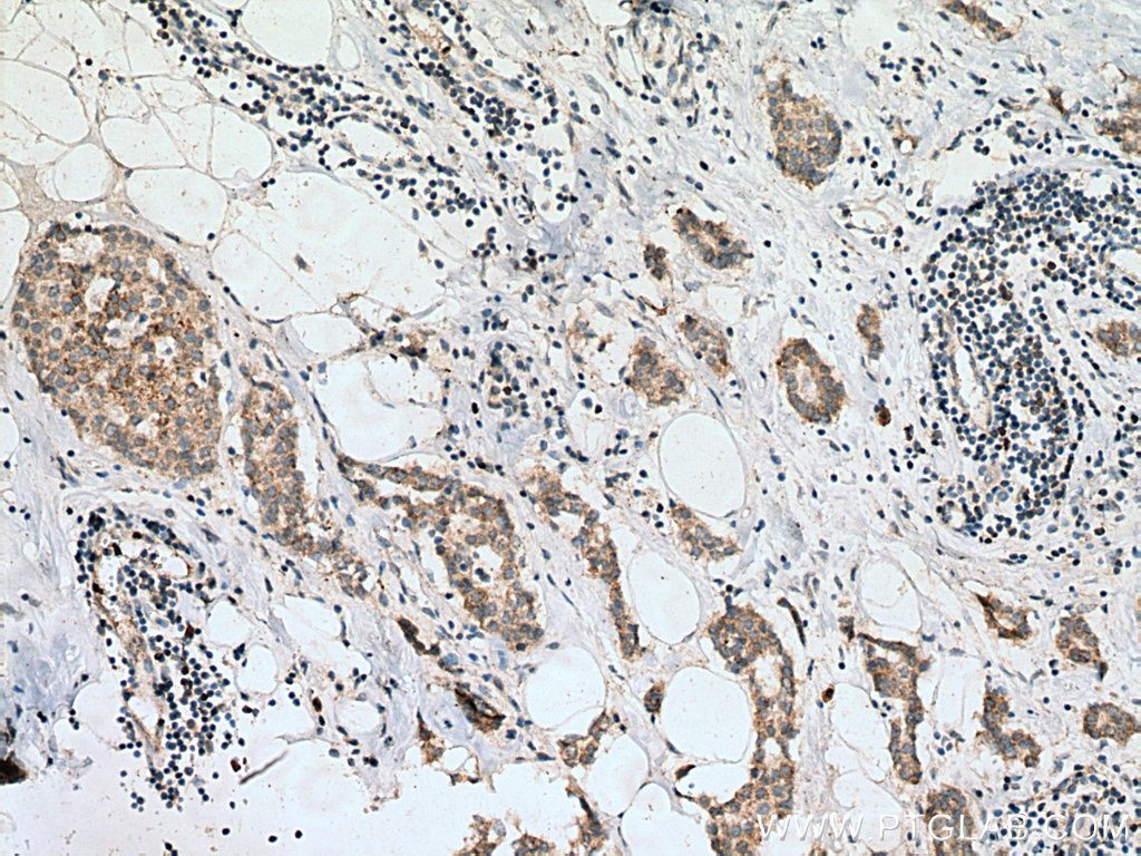Immunohistochemistry (IHC) staining of human breast cancer tissue using Bim Polyclonal antibody (22037-1-AP)