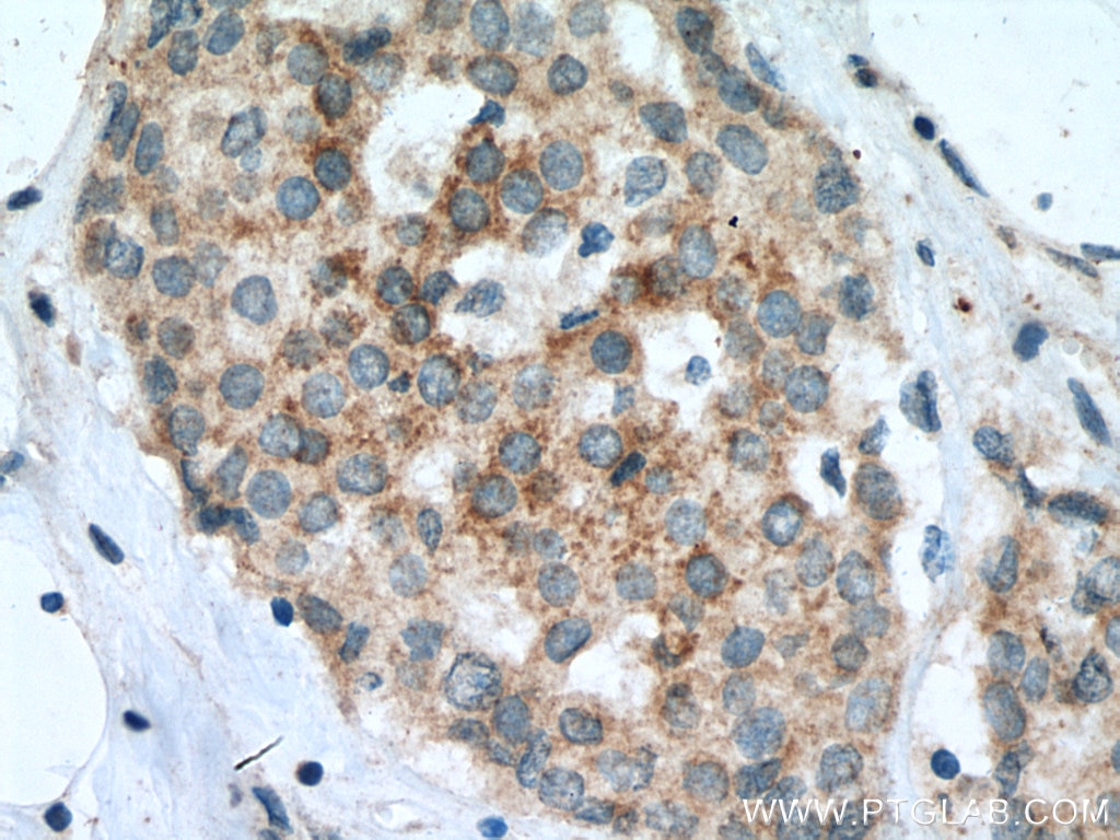 Immunohistochemistry (IHC) staining of human breast cancer tissue using Bim Polyclonal antibody (22037-1-AP)