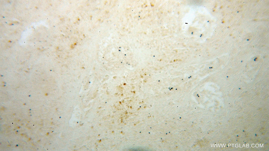 Immunohistochemistry (IHC) staining of human osteosarcoma tissue using BIN1 Polyclonal antibody (14647-1-AP)