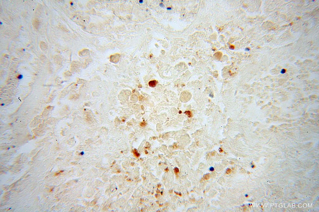 Immunohistochemistry (IHC) staining of human osteosarcoma tissue using BIN1 Polyclonal antibody (14647-1-AP)