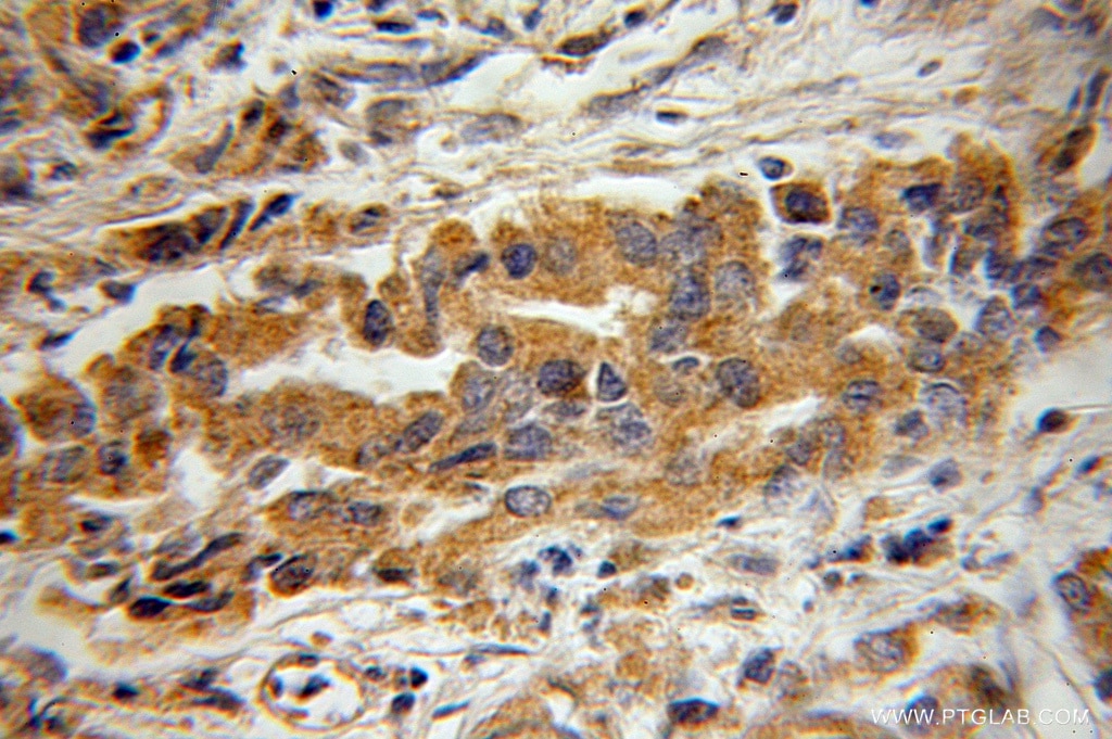 Immunohistochemistry (IHC) staining of human prostate cancer tissue using BIN3 Polyclonal antibody (11215-1-AP)