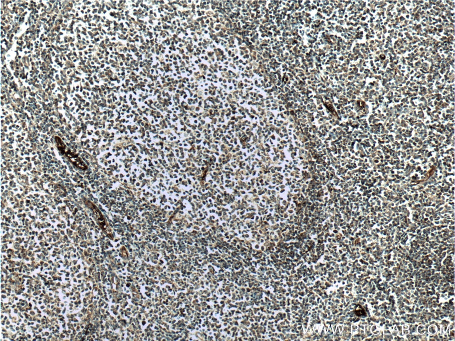 IHC staining of human tonsillitis using 24304-1-AP