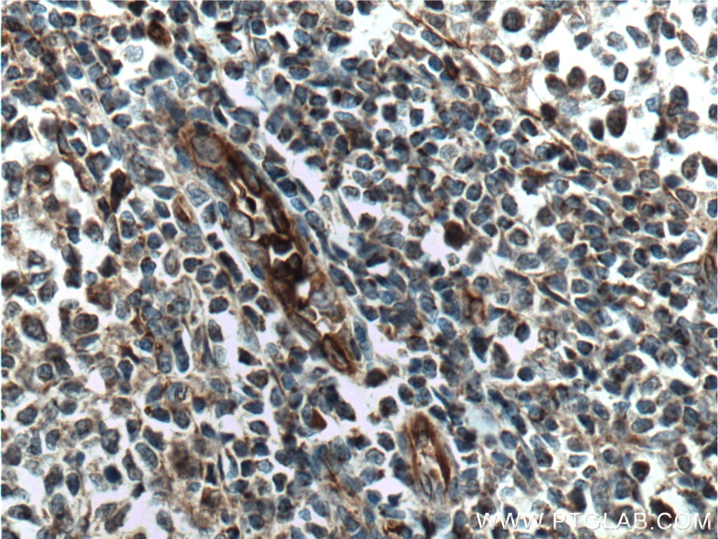 Immunohistochemistry (IHC) staining of human tonsillitis tissue using cIAP2 Polyclonal antibody (24304-1-AP)