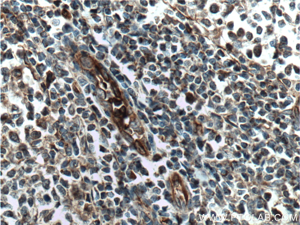 IHC staining of human tonsillitis using 24304-1-AP